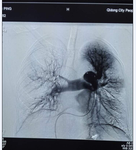 5肺栓塞病人第二天造影 血管已大部分开通.jpg