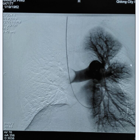 3DSA造影显示“右肺动脉栓塞”，符合CT诊断.jpg